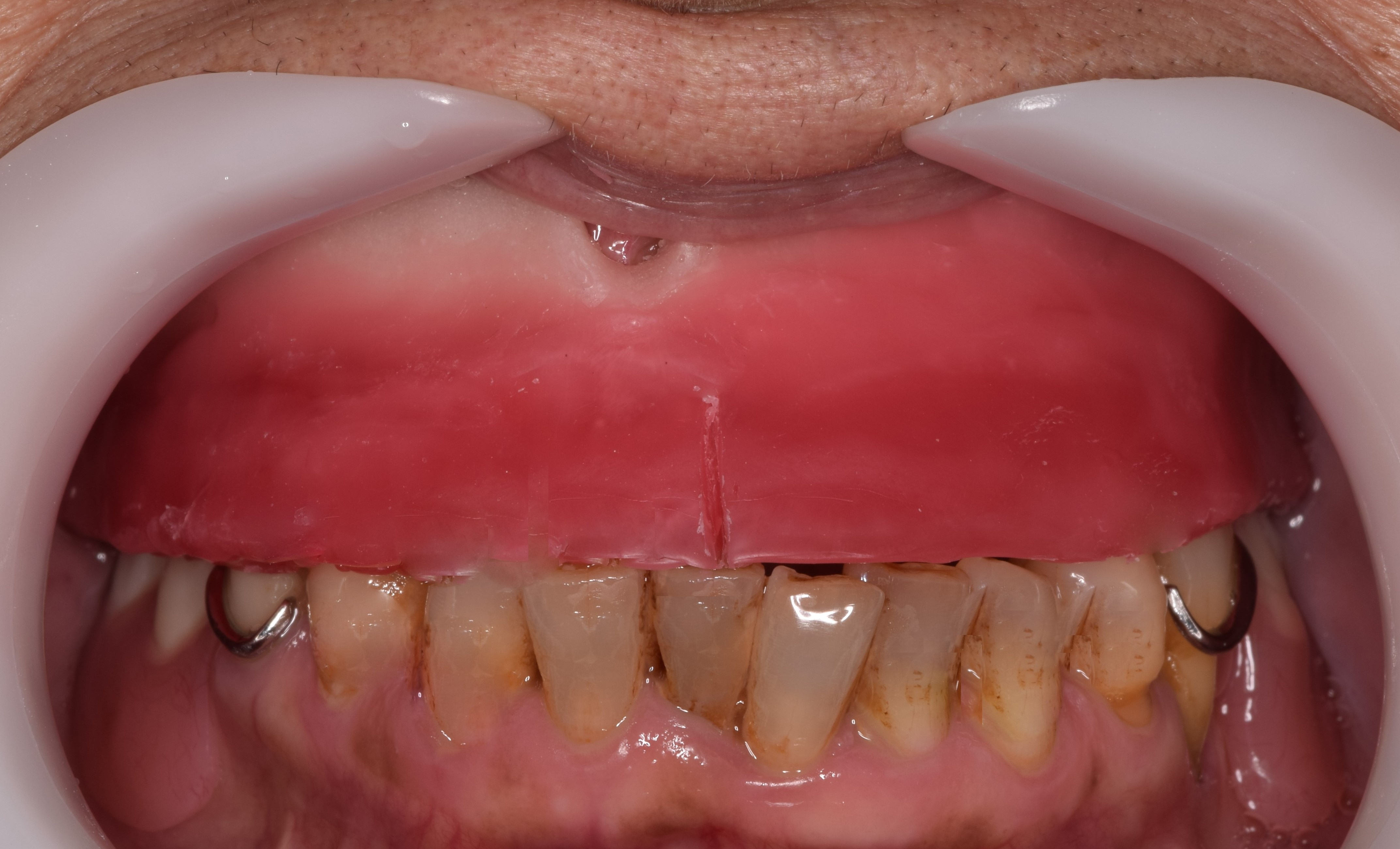 （３）噛み合わせ（高さや角度）の採得、人工歯の選択