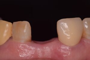 前歯欠損の場合の選択肢について（部分義歯のケース）