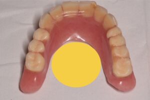安易に入れ歯を削ってしまった結果