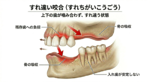 すれ違い咬合とは